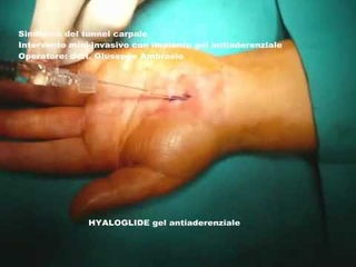 Декомпрессия срединного нерва (карпальный синдром) 2