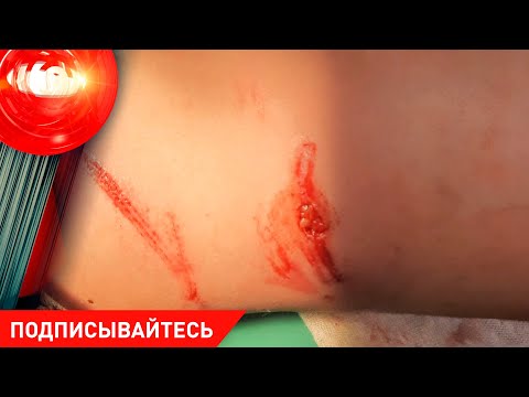 Собаки напали на людей Чем опасны вписки для детей И