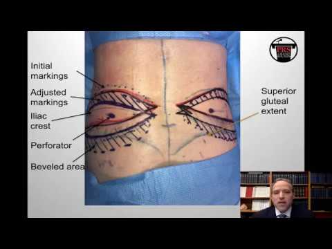 PRSGrand Rounds: Advanced Autologous Breast