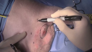 Удаление мастоцитомы в области промежности у собаки. Часть 1 / Perineal mast cell tumour removal in a dog