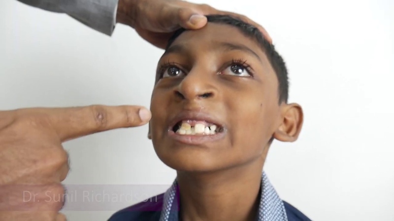 Cleft Palate Surgery Patient Before After Results with Dr. Sunil